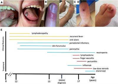 Case Report: Patient with deficiency of ADA2 presenting leukocytoclastic vasculitis and pericarditis during infliximab treatment